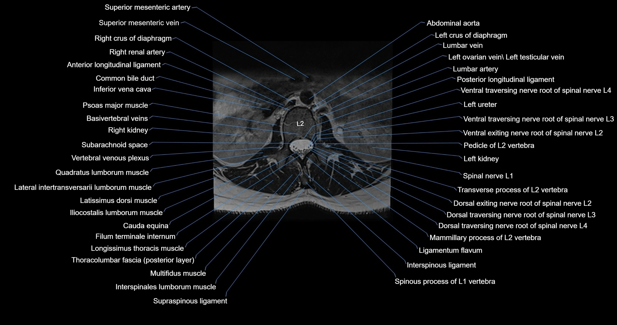 MRI lumbar spine axial cross sectional anatomy 3T radiology  image-img-00001-00014.webp